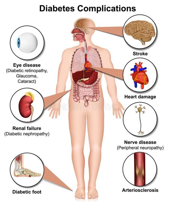 Consecuencias de la diabetes